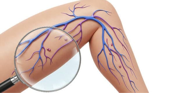 Medical illustration of a leg showing visible veins associated with chronic venous insufficiency